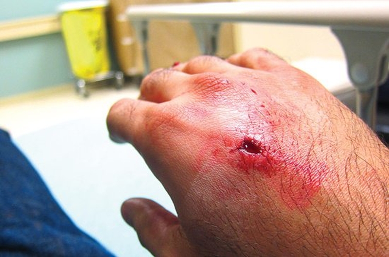 Bị chó cắn có sao không? Nguy hiểm tiềm ẩn sau vết cắn 2