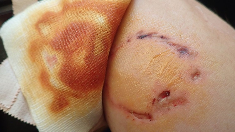 Đắp lá ớt không thể ngăn ngừa bệnh dại sau khi bị chó cắn