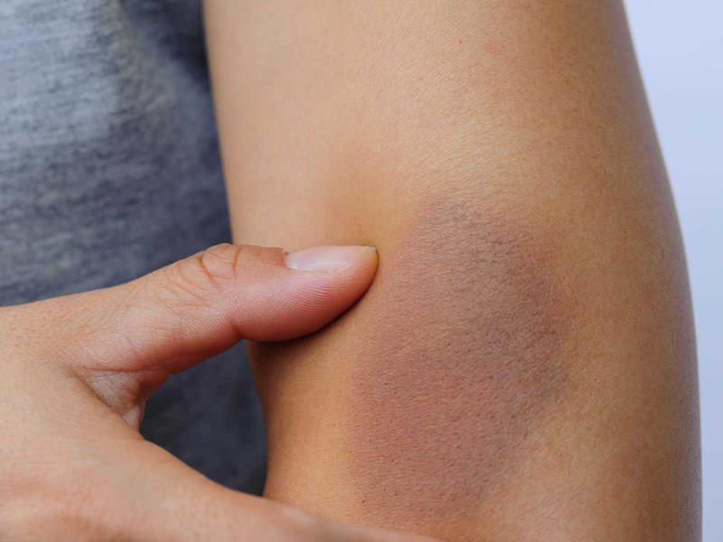 bị chó cắn không chảy máu chỉ bị bầm 2