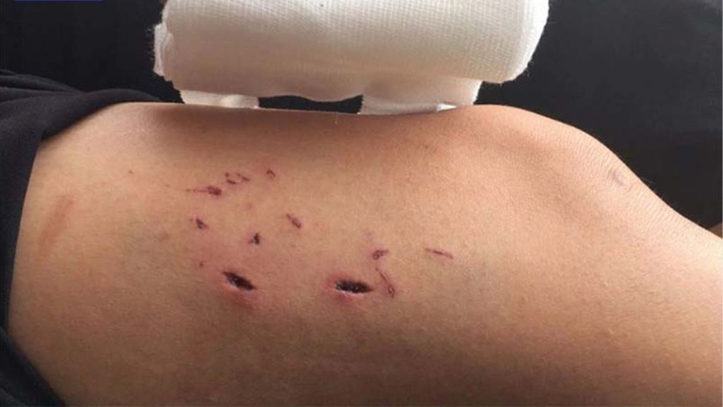 Bị chó cắn không chích ngừa có sao không? 1