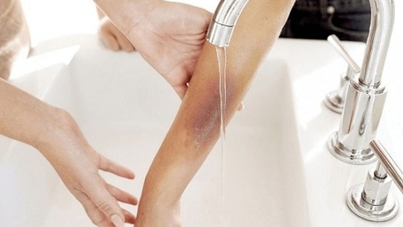 Bị chó cắn không chích ngừa có sao không? 3