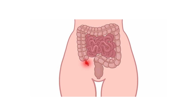 Bị đau bụng trên rốn sau khi ăn: Nguyên nhân và giải pháp 3