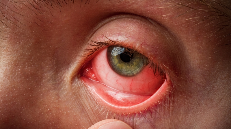 Đau mắt đỏ có thể tái phát, đặc biệt khi các yếu tố nguy cơ chưa được kiểm soát triệt để