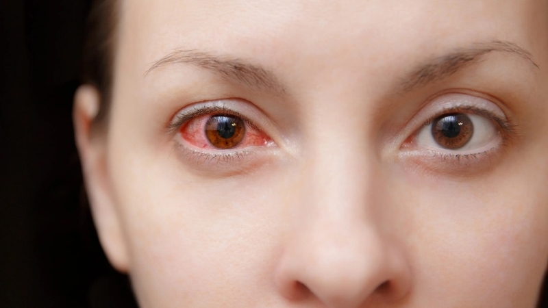 Bị đau mắt đỏ nhỏ thuốc gì khỏi bệnh nhanh và an toàn? 1