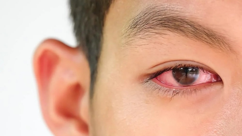 Bị đau mắt đỏ uống thuốc gì để bệnh nhanh hồi phục? 1