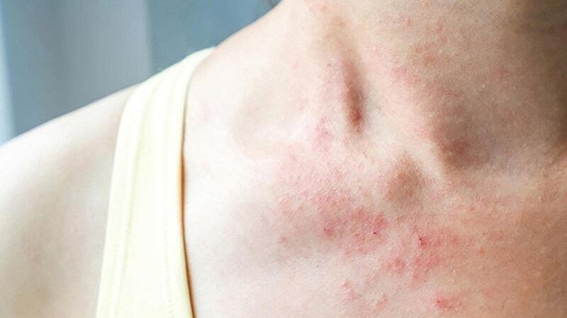 Bị dị ứng khăn giấy ướt phải làm sao? 2