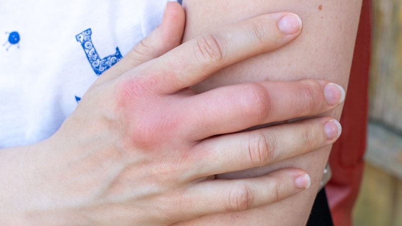 Khi bị dị ứng cần loại bỏ ngay tác nhân gây dị ứng