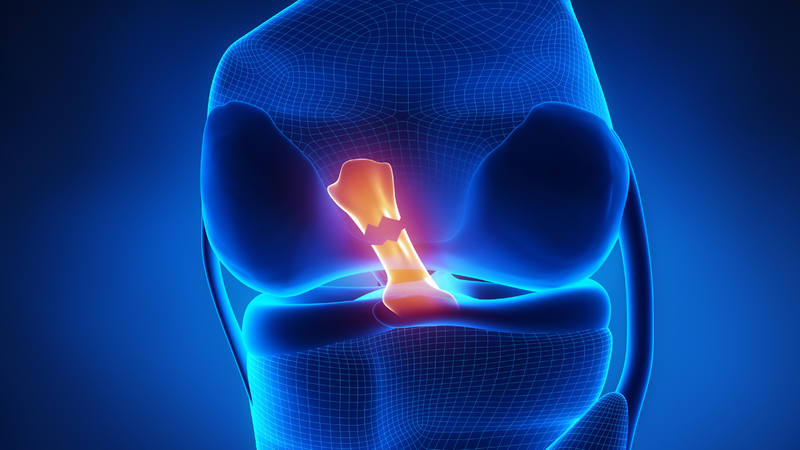 Đứt dây chằng chéo trước (ACL) gây hạn chế vận động, khó đi lại