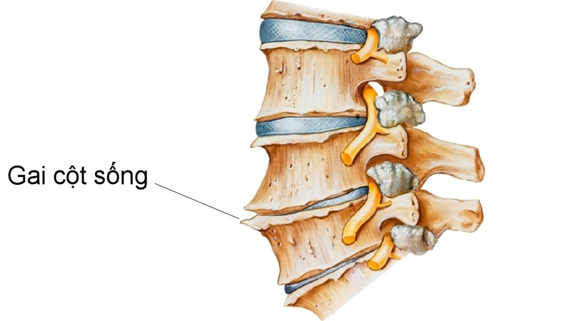 Bị gai cột sống có nên tập thể dục? Lưu ý khi tập thể dục 2