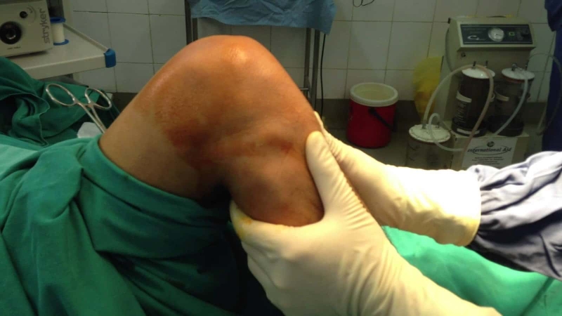 Dây chằng có thể bị giãn hoặc rách, tuỳ vào từng mức độ chấn thương mà có những phương pháp điều trị khác nhau