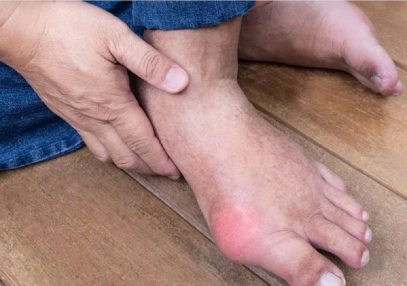 Bị gút có nên chườm đá lạnh không? Những điều bệnh nhân cần lưu ý 3