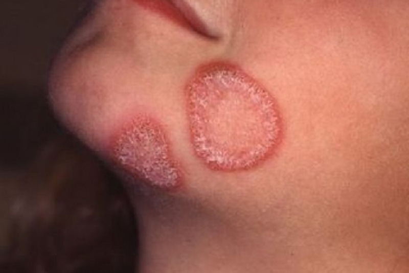 Bệnh hắc lào ăn vào máu có thể khiến bệnh tái phát nhiều lần và khó điều trị dứt điểm