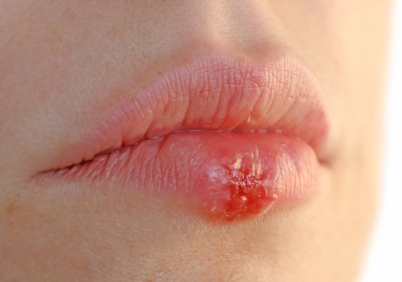 Bị herpes môi kiêng ăn gì và nên ăn gì để không bị viêm loét nhiều hơn? 1
