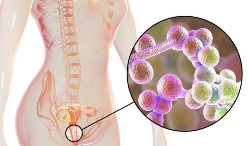 Bị khí hư vón cục màu vàng có đáng lo ngại không? Cách điều trị tình trạng ra khí hư vón cục màu vàng 3