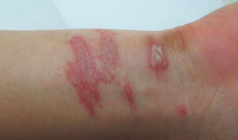 Bị kiến ba khoang cắn có bị sốt không? 1