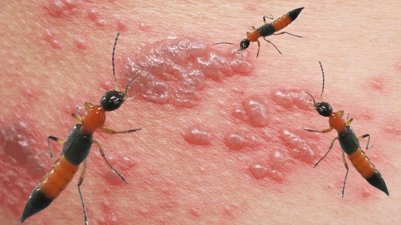 Bị kiến ba khoang cắn có được tắm không và tắm như thế nào 2