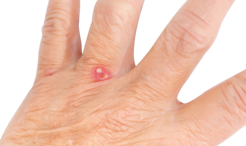 Bị kiến ba khoang cắn có kiêng nước không? Cách chăm sóc da mau lành 1