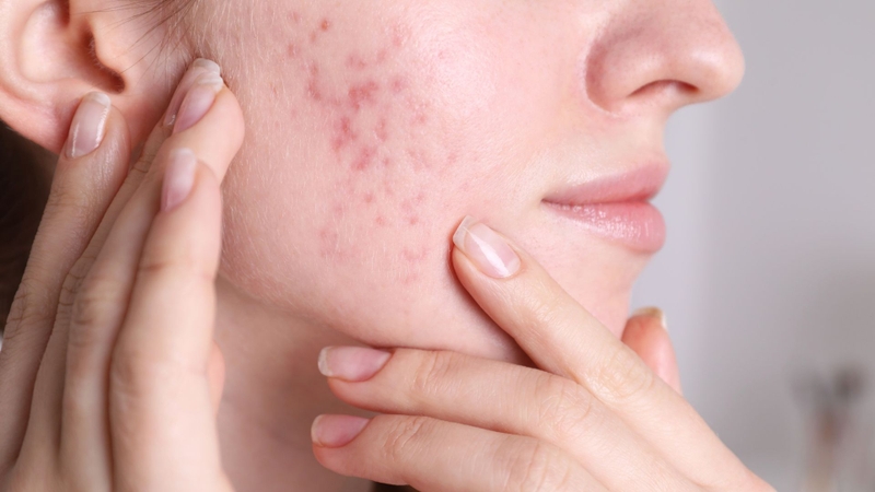 Mụn thâm có trị được ở nhà không là câu hỏi thắc mắc của nhiều người