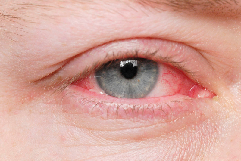 Bị mắt đỏ phải làm sao để khỏi tại nhà?1