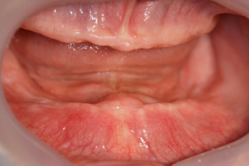 Bị mất răng toàn hàm phải làm thế nào để khắc phục?1