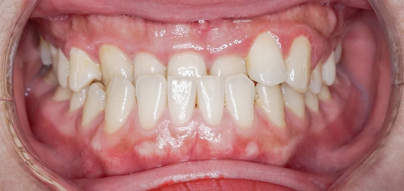 Bị móm có nên niềng răng? Quá trình niềng răng móm mất bao lâu? 1