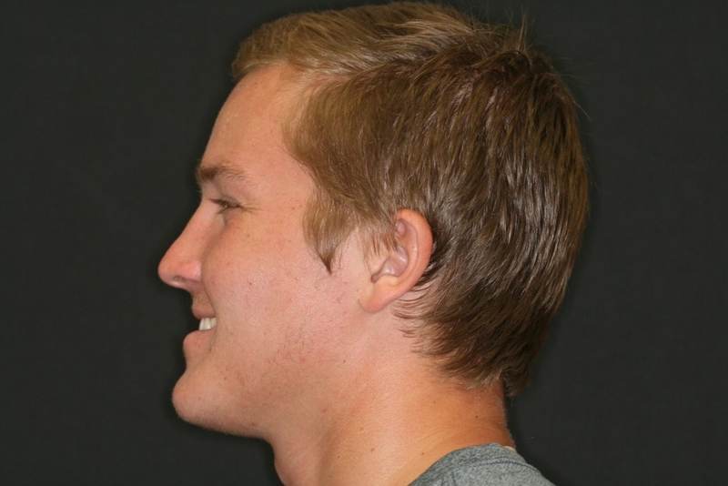 Bị móm có nên niềng răng? Quá trình niềng răng móm mất bao lâu?