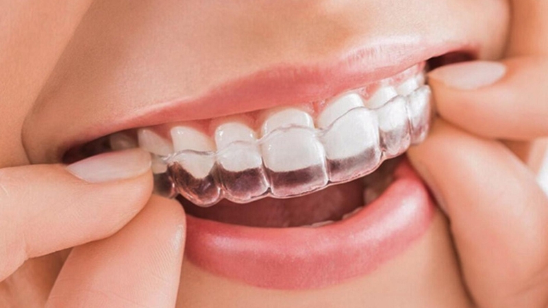 Bị móm có nên niềng răng? Quá trình niềng răng móm mất bao lâu? 3