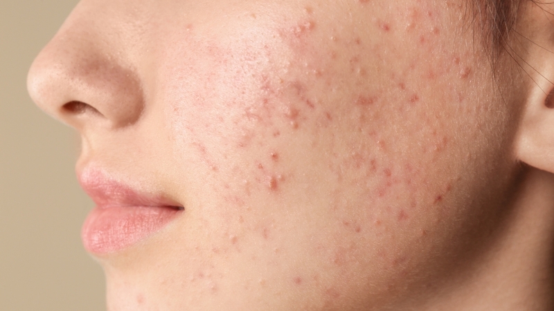 Nên đi khám khi mụn kéo dài, nặng, tái phát hoặc có nguy cơ để lại thâm sẹo