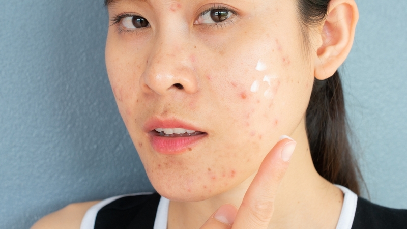Thuốc bôi giúp giảm mụn nhờ kháng khuẩn, làm sạch lỗ chân lông và chống viêm