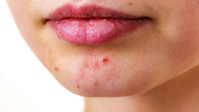 Bị mụn nội tiết nên uống gì mau hết? 5