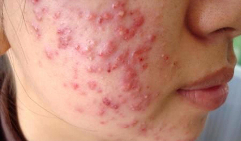 bi-mun-trung-ca-co-nen-dung-sua-rua-mat 1.jpg