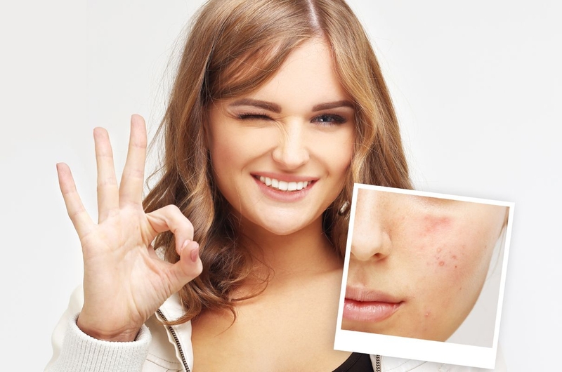 Bị mụn viêm có nên đắp mặt nạ đất sét không 4