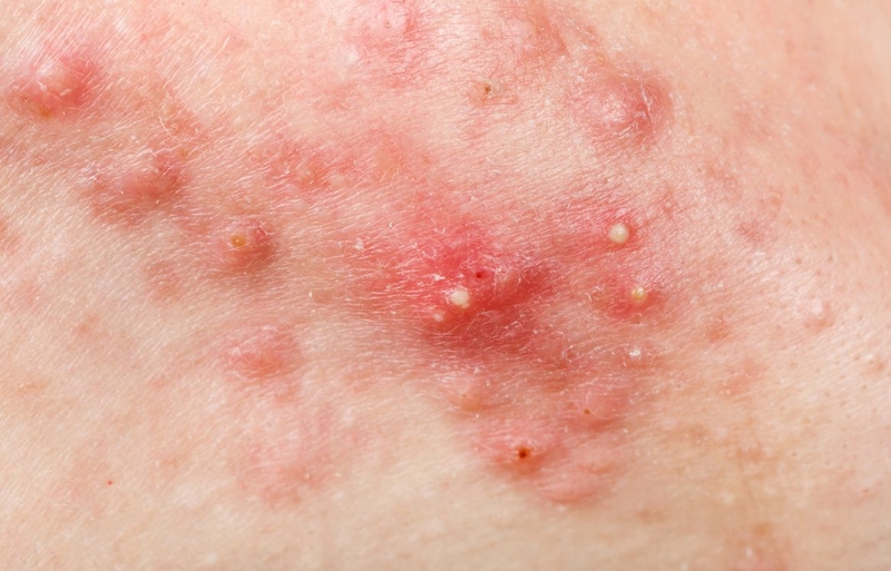 Bị mụn viêm nên làm gì? Hướng dẫn A - Z cách chăm sóc và điều trị 1