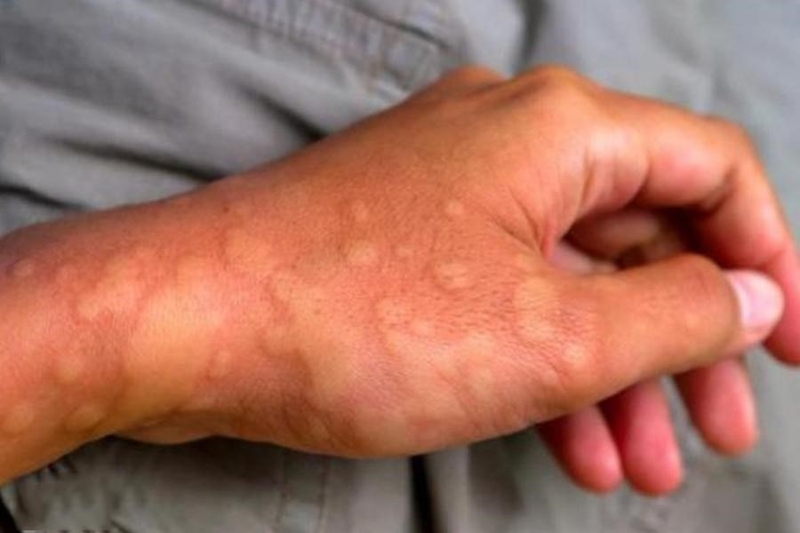 Bị muỗi đốt nhiều có sao không?