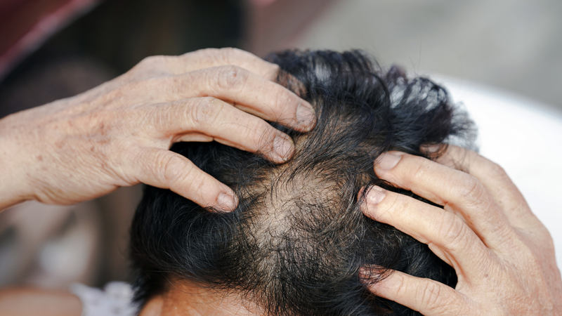 Bị nấm da đầu có gây rụng tóc không? 1