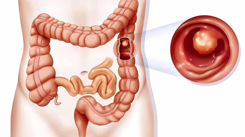 Bị ngứa hậu môn sau khi đi vệ sinh có sao không? 1