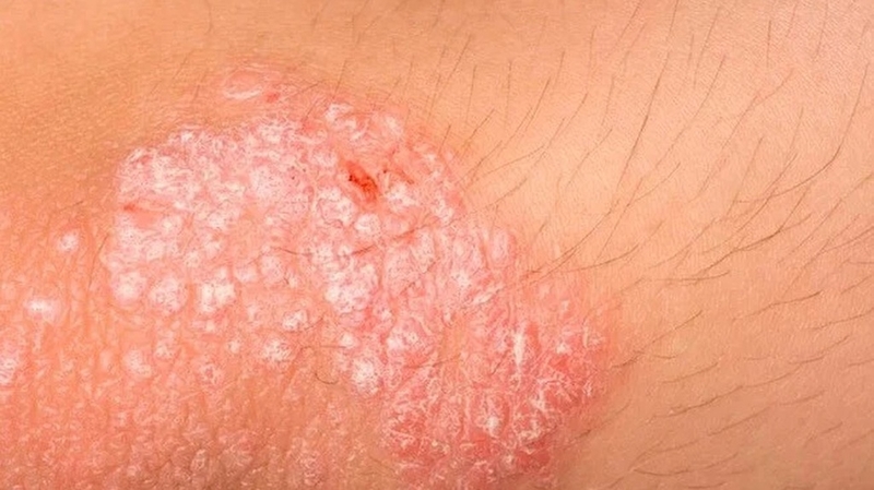 Bị ngứa hậu môn sau khi đi vệ sinh có sao không? 2