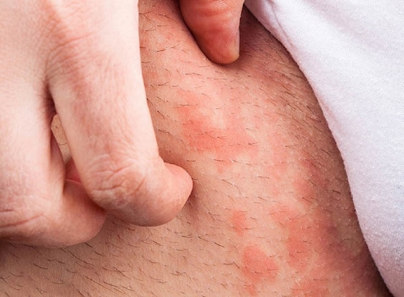 Bị ngứa vùng háng ở nam là bệnh gì? Nguyên nhân gây bị ngứa vùng háng ở nam 1