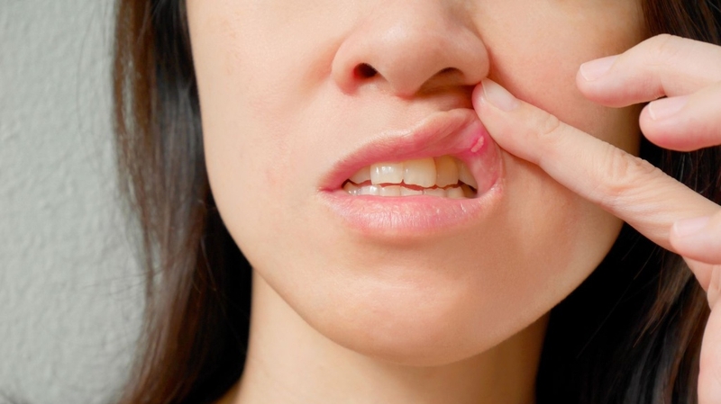 Bị nhiệt miệng có gây sốt không? Cách chữa trị nhiệt miệng hiệu quả 1