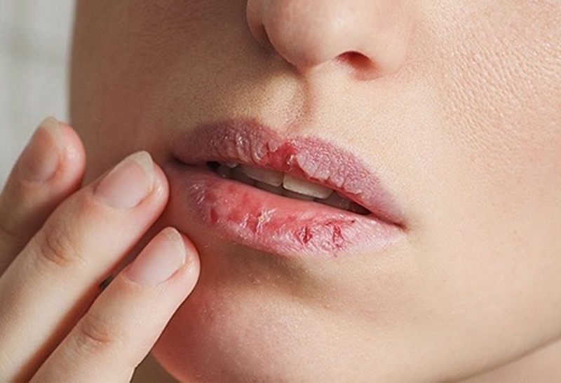 Bị nóng trong người phải làm sao? Các cách thanh nhiệt cơ thể 1