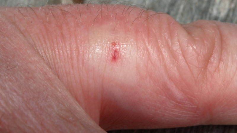 Phản ứng tại chỗ khi bị ong đốt là sưng đỏ, đau buốt, ngứa ngáy, đôi khi có mủ nếu nhiễm trùng 2