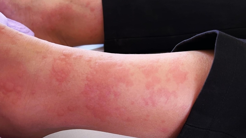 Bị ong mặt quỷ đốt phải làm sao? Có nguy hiểm không 2