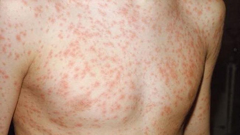 Bị phát ban có nằm máy lạnh được không? 1