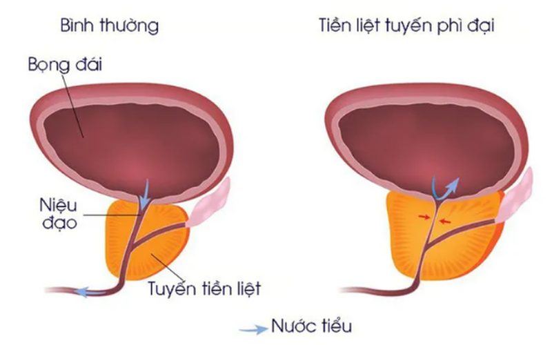Bị phì đại tuyến tiền liệt uống gì cho nhanh khỏi 1