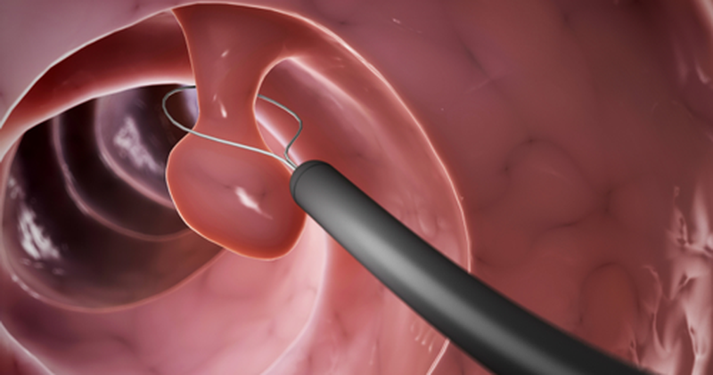 Bị polyp cổ tử cung có quan hệ được không? Làm sao để chữa trị? 4