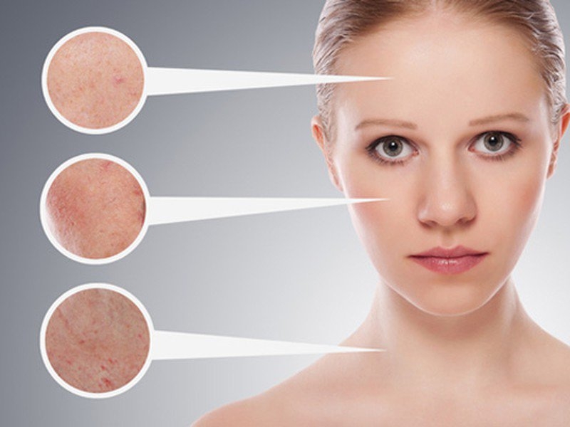 Bí quyết chăm sóc cho da mặt nhờn và lỗ chân lông to hiệu quả 1
