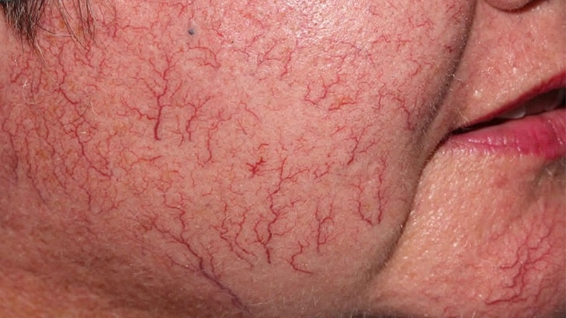 Bí quyết phục hồi da bị giãn mao mạch chỉ sau 2 tháng! 3