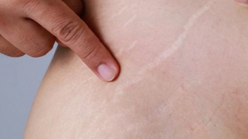 Bí quyết trị rạn da lâu năm không phải ai cũng biết 1