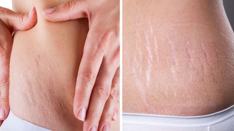 Bí quyết trị rạn da lâu năm không phải ai cũng biết 2