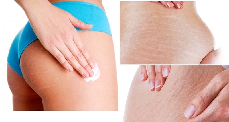 bị rạn da mông màu trắng 3